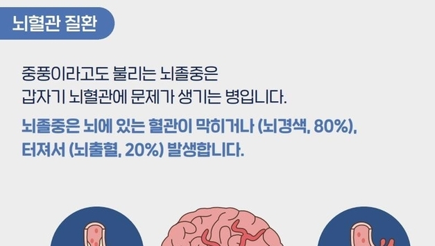 뇌졸증 예방·치료 5가지 실천수칙 지켜야…오늘 '세계 뇌졸중의 날'